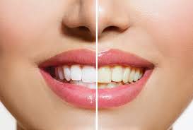 That's why it's important to try to avoid staining teeth in the first place, especially after whitening. Can I Use Whitening Products With Braces By Robert Rudman Medium