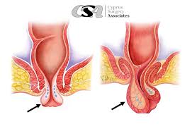 Image result for Rectal prolapse