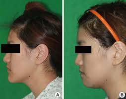 Case 1: preoperative and postoperative photographs Horizontal and...