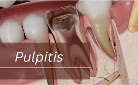 Image result for Pulpitis