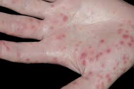 Sejumlah gejala yang bisa muncul saat hendak menstruasi seperti berjerawat, kram perut, hingga perubahan mood. Penyakit Hfmd Pada Anak Apa Yang Ibu Bapa Wajib Tahu Theasianparent Malaysia