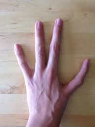 I Have Only Four Fingers On My Left Hand And Have And Index Finger Instead Of My Thumb Genetics Alien Hand Syndrome Index Finger