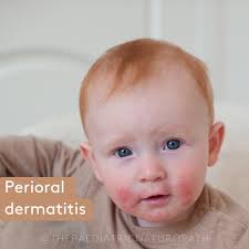Image result for dermatitis contacta children