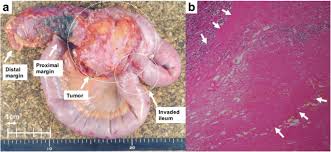 You should know if the goal of treatment is treatment choices for advanced cancer depend on the type of cancer, where the cancer started, and how much it has spread into the area around it. Pathological Complete Response Of Locally Advanced Colon Cancer After Preoperative Radiotherapy A Case Report And Narrative Review Of The Literature Surgical Case Reports Full Text
