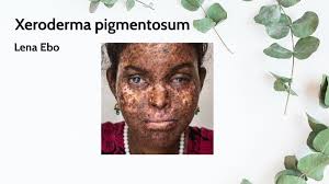 Xeroderma pigmentosum (xp) was first described in 1874 by hebra and kaposi. Xeroderma Pigmentosum By Lena Ebo On Prezi Next