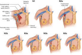 Image result for Breast Cancer Staging