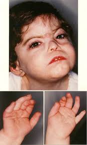 Abnormal Body Size and Proportion