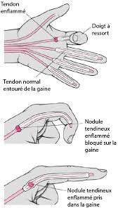 Doigt A Ressaut Troubles Osseux Articulaires Et Musculaires Manuels Msd Pour Le Grand Public