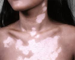 Image result for Vitiligo