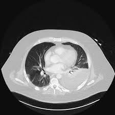 higher density measurements on ct forblood. Pleural Effusion Supine Radiology Case Radiopaedia Org