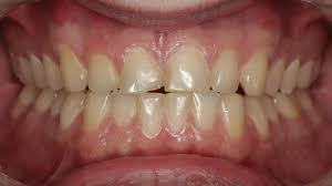 How occlusion can affect a single-tooth replacement