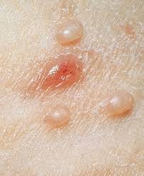 Molusco Contagioso: Tratamento com Óleos Essenciais - Óleos Essenciais | O  Guia do Brasil