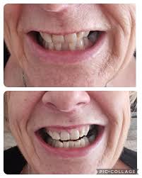 Cumbria Laser Teeth Whitening