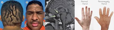 Image result for Acromegaly