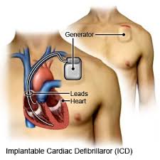 The leads are wires with electrodes at the tip that transmit electrical signals to and from the heart muscle. Implantable Cardioverter Defibrillator Discharge Care What You Need To Know