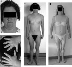 Image result for Lipodystrophy