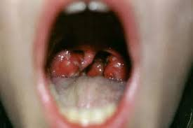 Image result for Scarlet Fever