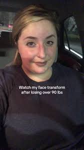 Transformation Journey: Overcoming Acne and Weight Loss