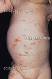 Image result for Urticaria pigmentosa children