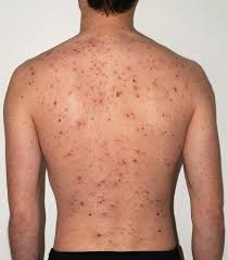 Image result for Varicella zoster on human skin
