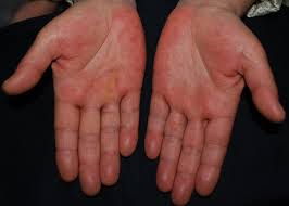 Primary or physiologic pe can be due to heredity, occurs in at least 30% of pregnant … Lane S Disease Erythema Palmare Hereditarium A Report Of Five Cases And A Review Of The Literature Gurioli 2017 Pediatric Dermatology Wiley Online Library