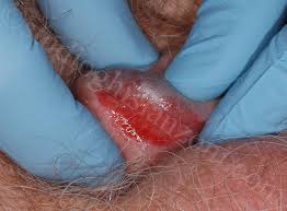 Balanite di Zoon: immagini cause e cure | Studio Ghislanzoni