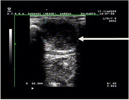Ultrasound (us) of the central neck compartment (cnc) is considered of limited sensitivity for nodal spread in papillary thyroid cancer (ptc) our findings emphasize the ability of us to clinically detect relevant nodal disease and support conservative management of the cnc in the. Local Metastasis In Head And Neck Cancer An Overview Intechopen