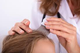 Image result for lice vs dandruff