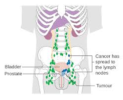Fever is rarely an early sign of cancer but may be if a person has cancer spread to the liver • lumps near the surface of the body, due to cancer spreading to the skin or to lymph nodes (collections of immune system. File Diagram Showing Prostate Cancer That Has Spread To The Lymph Nodes Cruk 184 Svg Wikimedia Commons