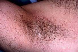 Pubic Lice Or Crab Lice Signs Symptoms Transmission Pubic Lice Treatment