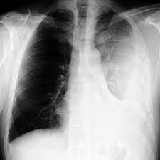 B, pleural fluid within a locule; Large Loculated Pleural Effusion 1 Of 3 Pleural Effusion Radiology Thorax