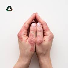 Lesões em forma de gotas associadas a processos infecciosos. Psoriase Pacientes Enfrentam A Doenca E O Preconceito