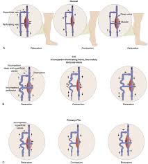 Image result for Perthes Test