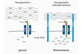 Die krankheit beeinträchtigt die funktion verschiedener organe, vor allem aber der lunge und des verdauungsapparats. Mukoviszidose Ursache Ist Ein Gendefekt