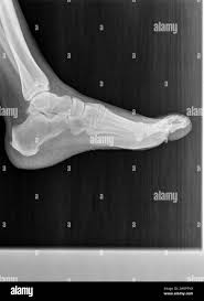 Image result for Foot XRay