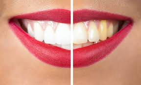 Image result for Tooth Discoloration