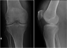 Image result for Septic Joint