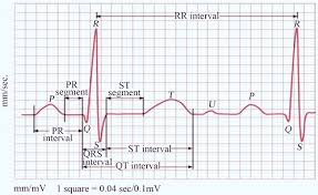 Image result for Pulseless Electrical Activity