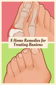 8 Home Remedies For Treating Bunions Bunion Remedies Bunion Remedies