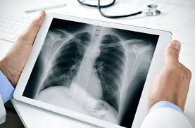 X Ray Myths Debunked Treatment Mesothelioma Face Cancer