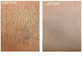 We are the largest laser hair removal company in the nation that offers unlimited treatments with every purchase. Laser Hair Removal Grand Rapids Renewal Skin Spa