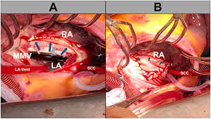 Image result for Endocardial Cushion Defect