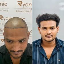 Best Hair Transplant in India