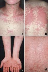 ¨ anemia caused by mechanical damage to erythrocytes: Ampicillin Induced Cutaneous Eruption Associated With Epstein Barr Virus Reactivation Journal Of The American Academy Of Dermatology