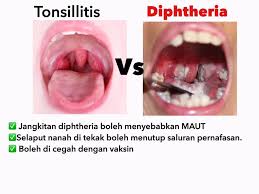 Jika anda ingin bertanyakan soalan ataupun berkongsikan pengalaman anda. 5 Cara Bezakan Penyakit Difteria Dengan Tonsil Biasa