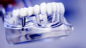 Check spelling or type a new query. Why Insurance Won T Cover Dental Implants