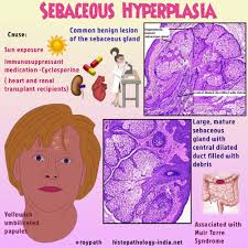 Image result for Sebaceous Gland