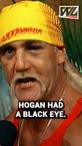 Why Hulk Hogan had a Black Eye At Wrestlemania