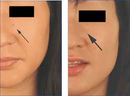 If you notice that it has gone black, then allow it to fall off naturally. Cherry Hemangiomas Before And After Pictures
