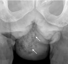 He subsequently moved into the nightclub industry, and then boxing. Image Fournier Gangrene X Ray Msd Manual Professional Edition